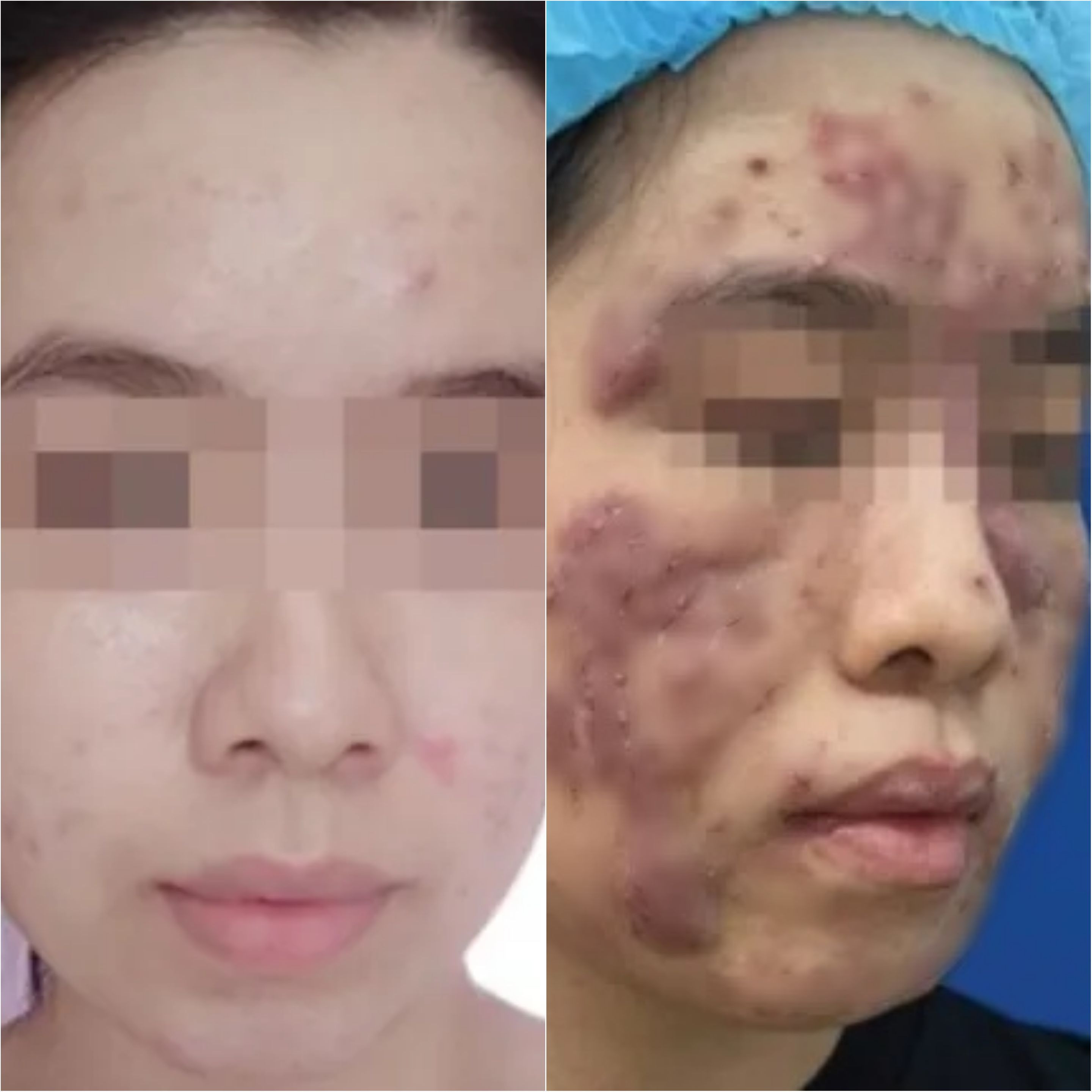 Cô gái 19 tuổi biến dạng mặt, nguy cơ mù vì đơn thuốc của 'bác sĩ online'